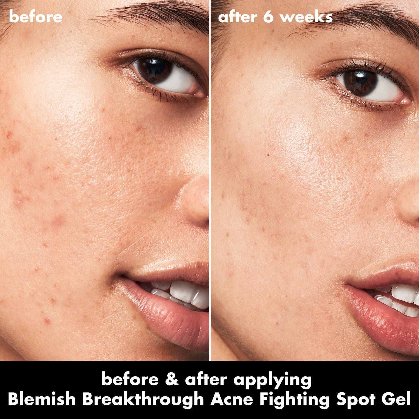 blemish-breakthrough-acne-fighting-spot-gel-o0 0326_EDU_BB_SpotGel_BA_ISABELLA.jpg