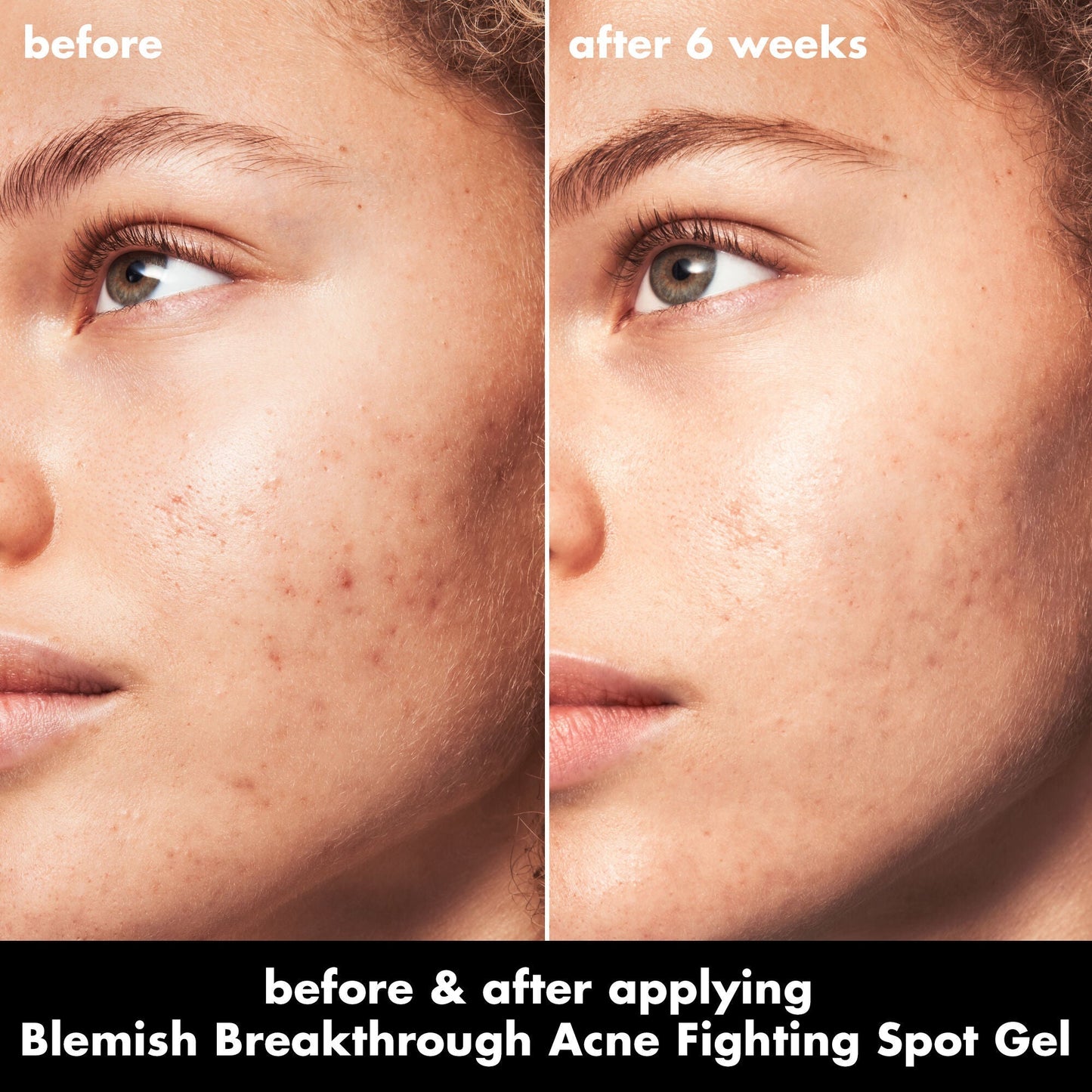 blemish-breakthrough-acne-fighting-spot-gel-o0 0326_EDU_BB_SpotGel_BA_MARLEY.jpg