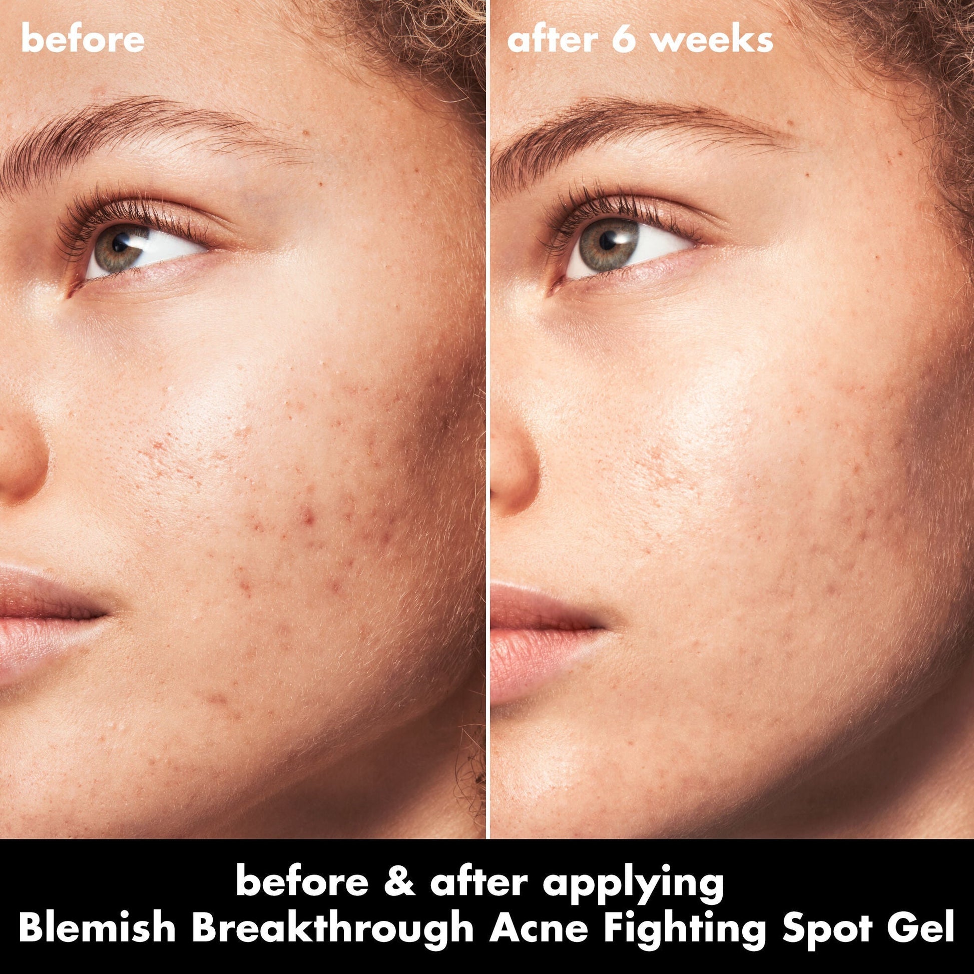 blemish-breakthrough-acne-fighting-spot-gel-o0 0326_EDU_BB_SpotGel_BA_MARLEY.jpg
