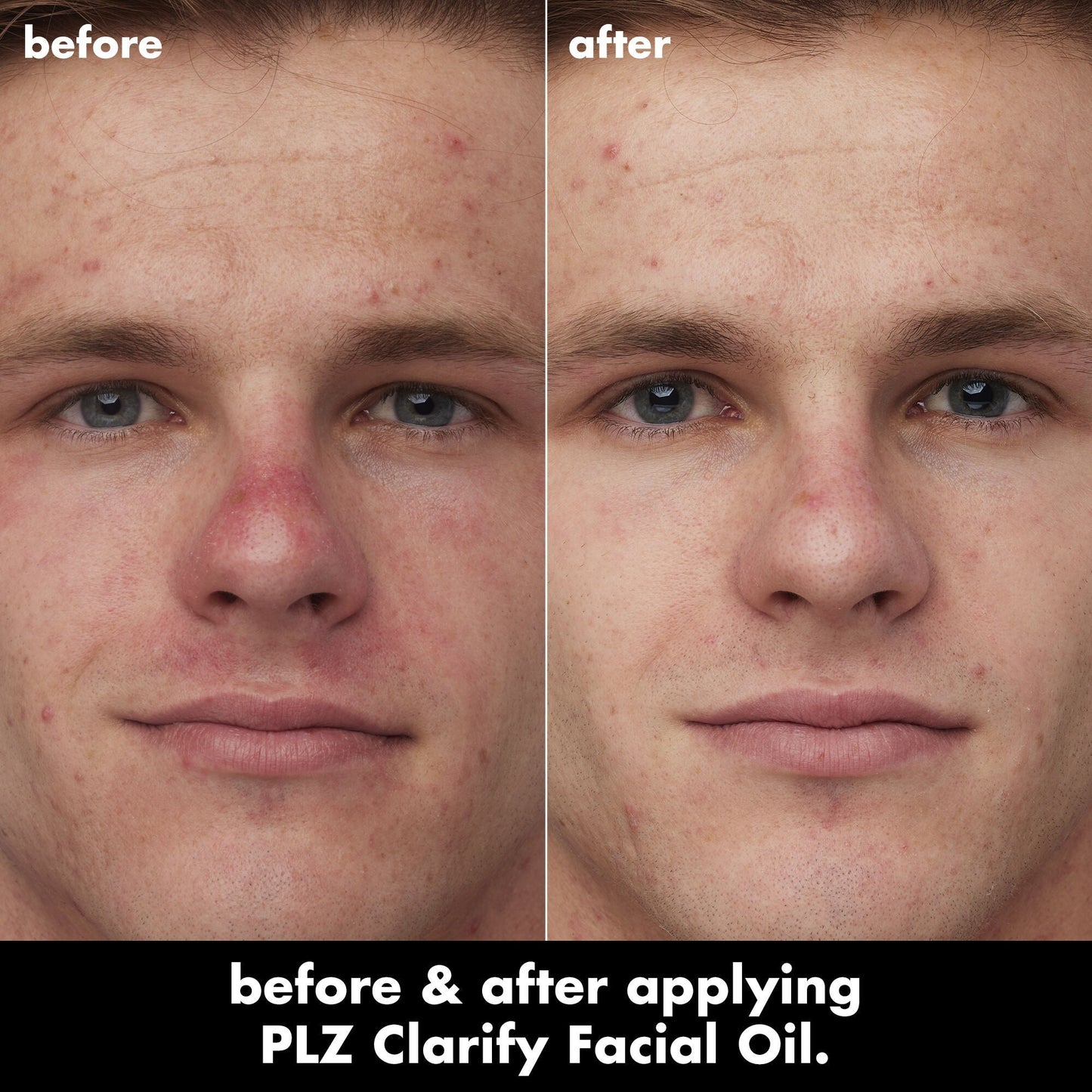 plz-clarify-facial-oil-w3 0326_EDU_PlzClarify_BA_Caleb.jpg