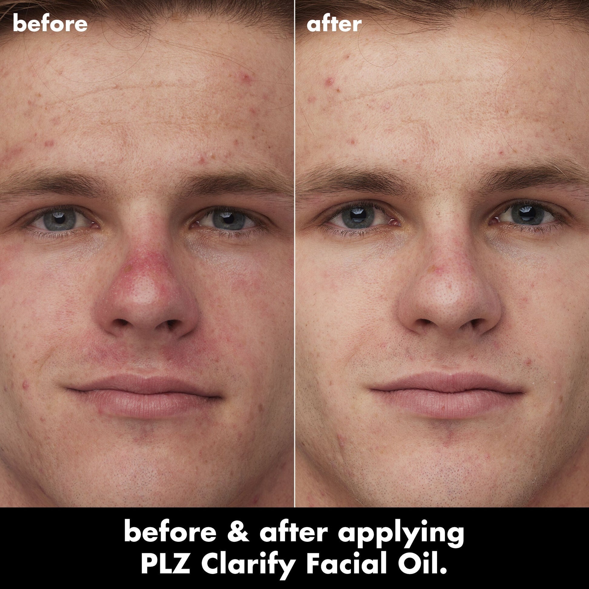 plz-clarify-facial-oil-w3 0326_EDU_PlzClarify_BA_Caleb.jpg