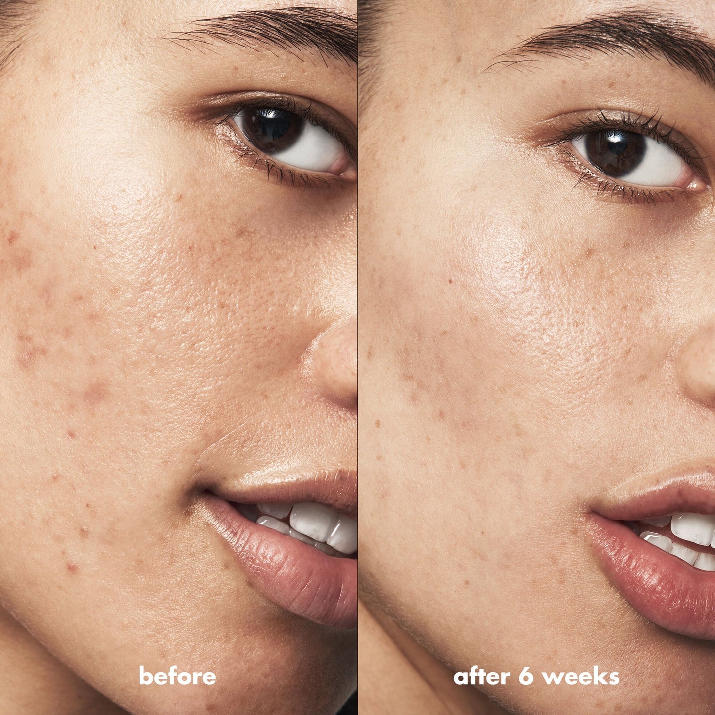 blemish-breakthrough-triple-acid-resurfacing-serum-o9 Acne_PDP_Isabella_Before_After_b8fe0505-ae5c-4baa-9a8e-fd889e4c3414.jpg