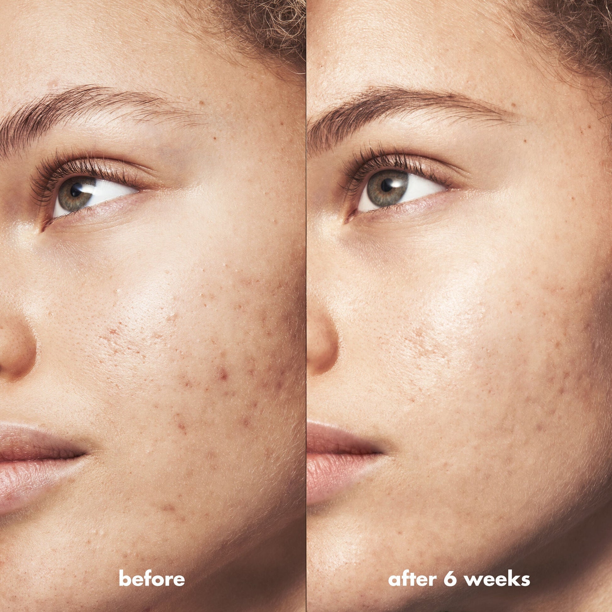 blemish-breakthrough-acne-calming-water-cream-y1 Acne_PDP_Marley_Before_After_be0f6ee7-ce12-4695-83d7-5ec5f0498e19.jpg